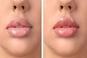 Treatment of black lips
